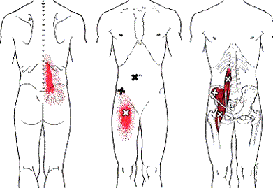 http://www.chiropracticvictoria.ca/uploads/6/5/9/8/65981573/psoas-trigger-point-pain_orig.png